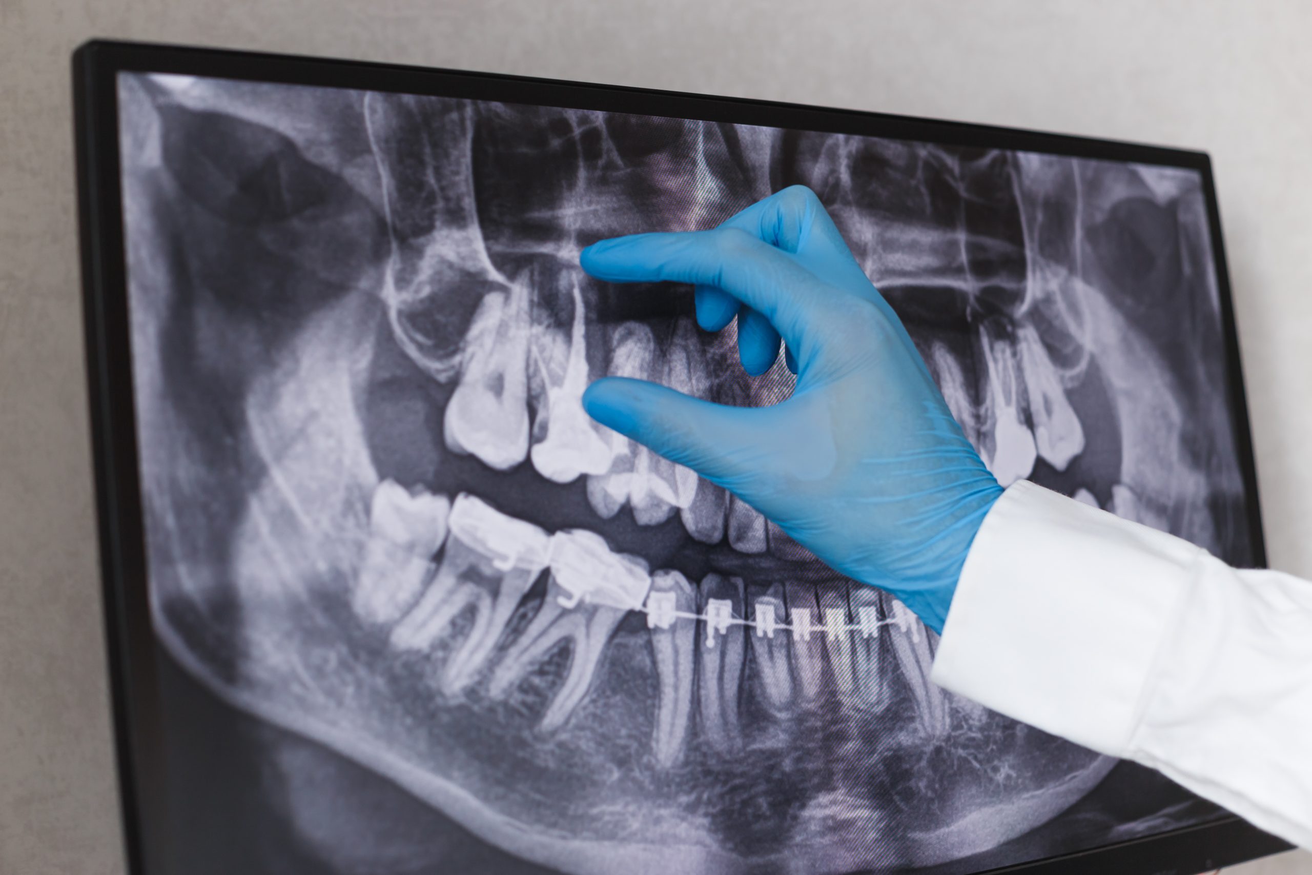 Doctor Points To Filled Root Canal In Dental X Ray